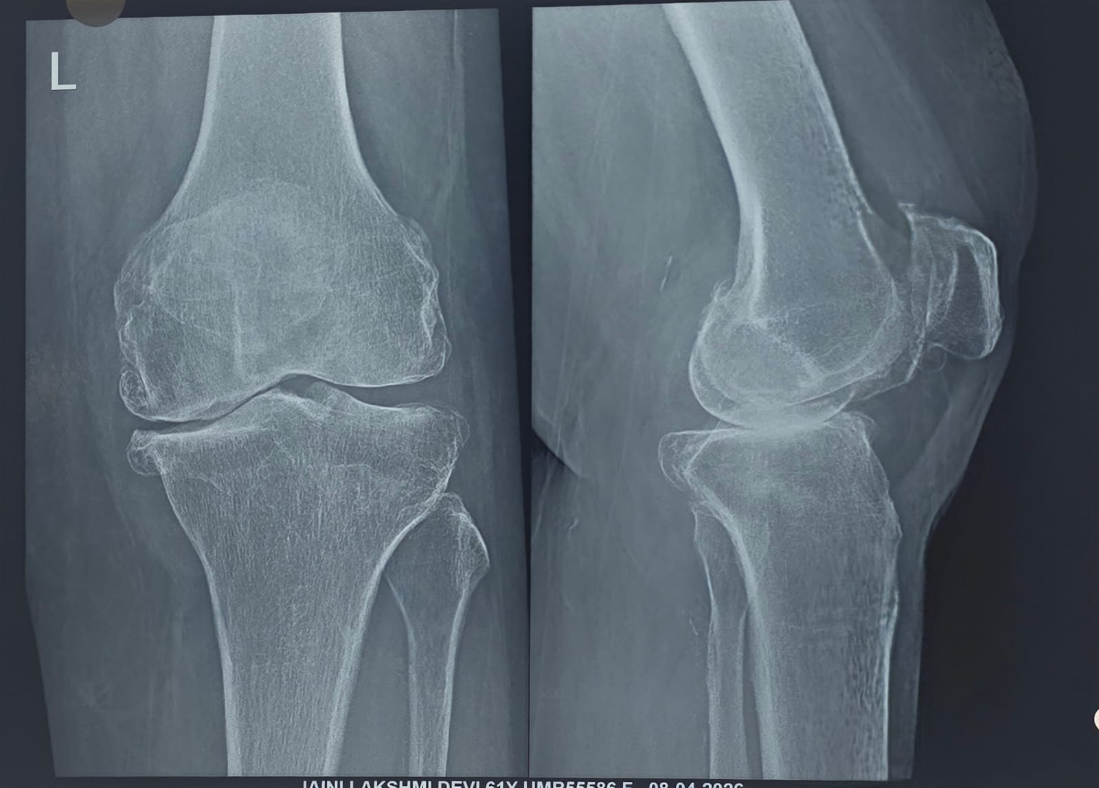 Before knee replacement close-up X-ray showing arthritic joint